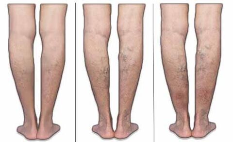 Stadiums of varicose veins