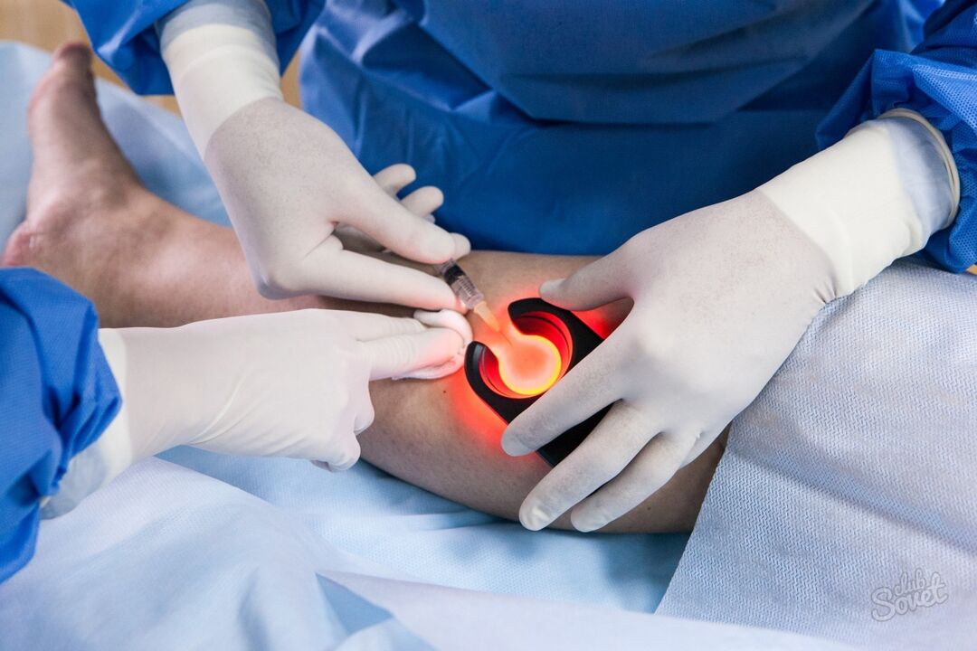 Varicose veins on leg diagnostics