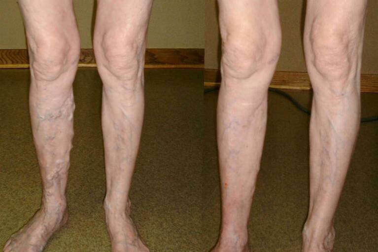 Varicose veins in men