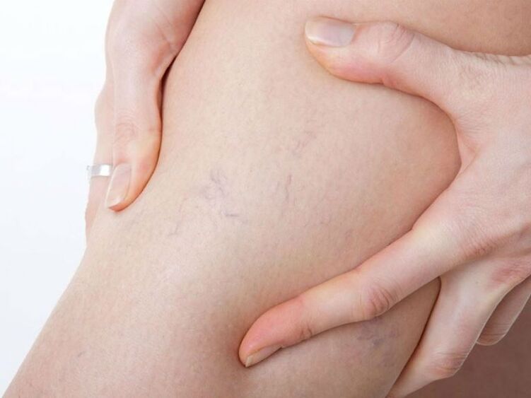 Varicose veins on the legs