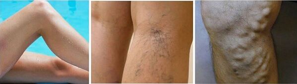 The appearance of varicose veins on the feet