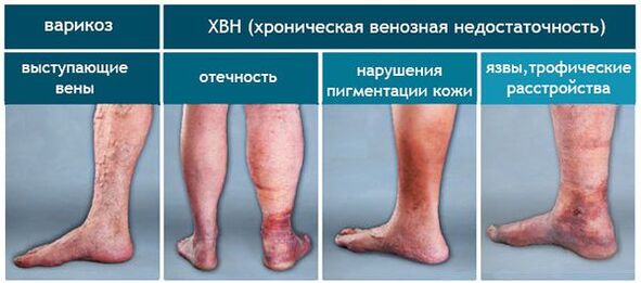 Stadiums of varicose veins