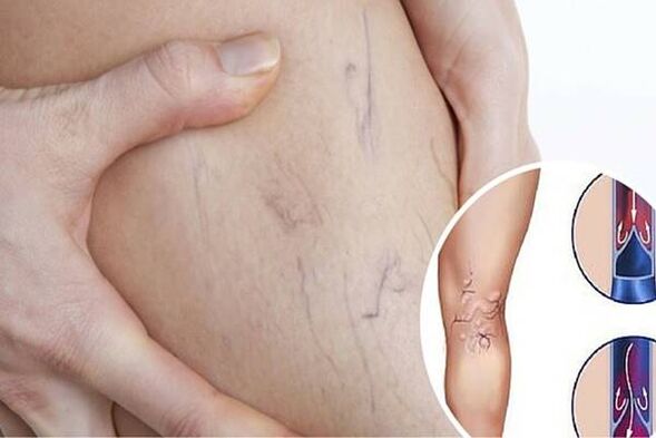 Varicose veins photo