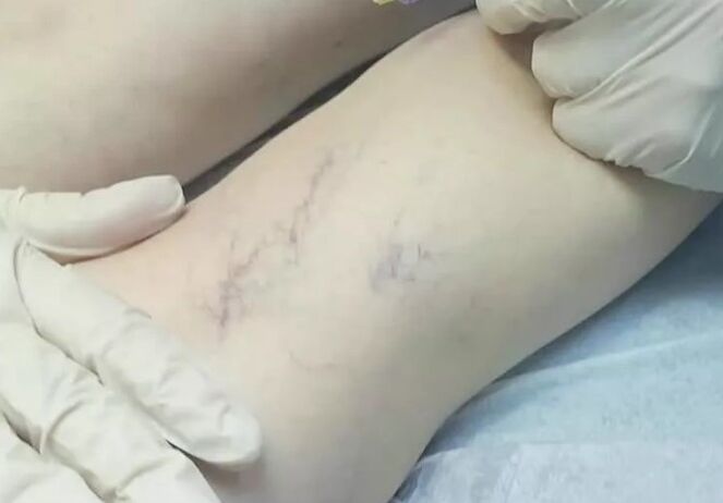 Complications after the operation