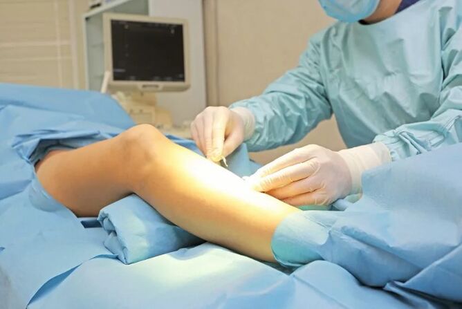 Operation to remove veins on the legs