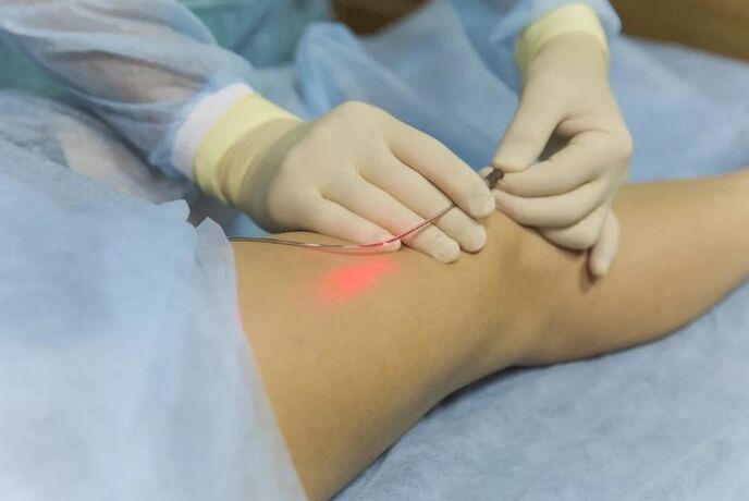 Treatment of varicose veins with a laser