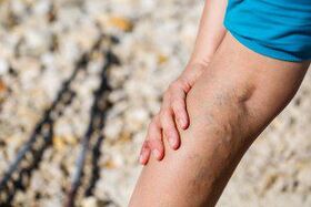 Varicose veins of the legs