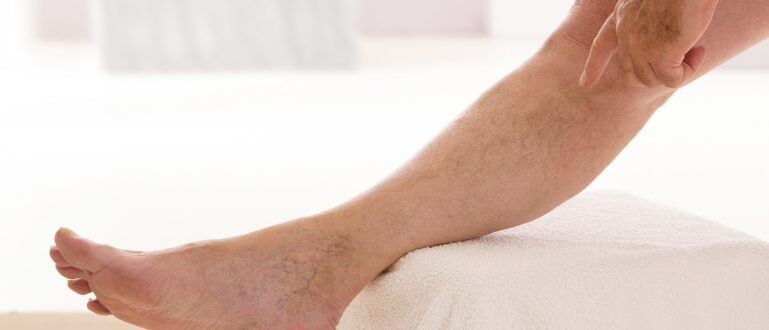 Varicose veins on the legs